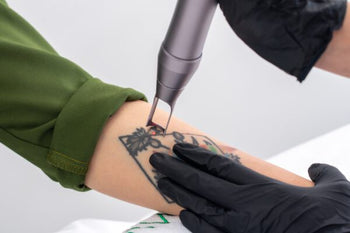 Tattoo verwijderen groot pakket 7-10cm